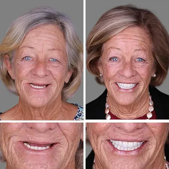 Ends Today: 60% OFF! ⏰Custom-Fit Instant Smile Dentures – Natural Looking Comfort Fit