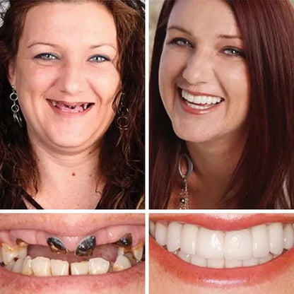 Ends Today: 60% OFF! ⏰Custom-Fit Instant Smile Dentures – Natural Looking Comfort Fit