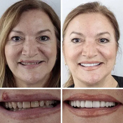 Ends Today: 60% OFF! ⏰Custom-Fit Instant Smile Dentures – Natural Looking Comfort Fit